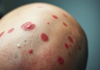 Trądzik głowy – przyczyny, objawy i skuteczne leczenie Trądzik głowy – przyczyny, objawy i skuteczne leczenie