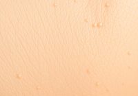 Rogowacenie okołomieszkowe: przyczyny, objawy i skuteczne leczenie