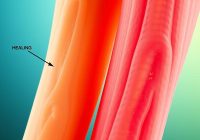 Zapalenie ścięgien: przyczyny, objawy i metody leczenia Zapalenie ścięgien: przyczyny, objawy i metody leczenia