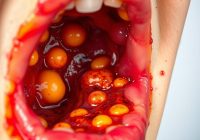 Stany ropne w jamie ustnej – przyczyny, objawy i leczenie