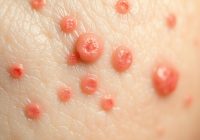 Jak rozpoznać trądzik grzybiczy? Objawy i leczenie krok po kroku